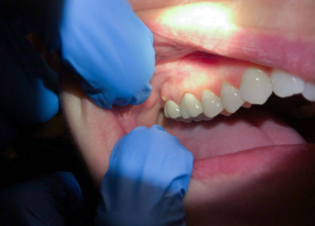 Best Dentist for Tooth Abscess  in Fort Defiance, AZ